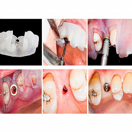 cirurgia guiada