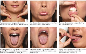 Preveno de Cncer Bucal