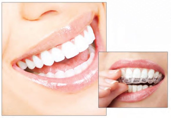 Clareamento Dental