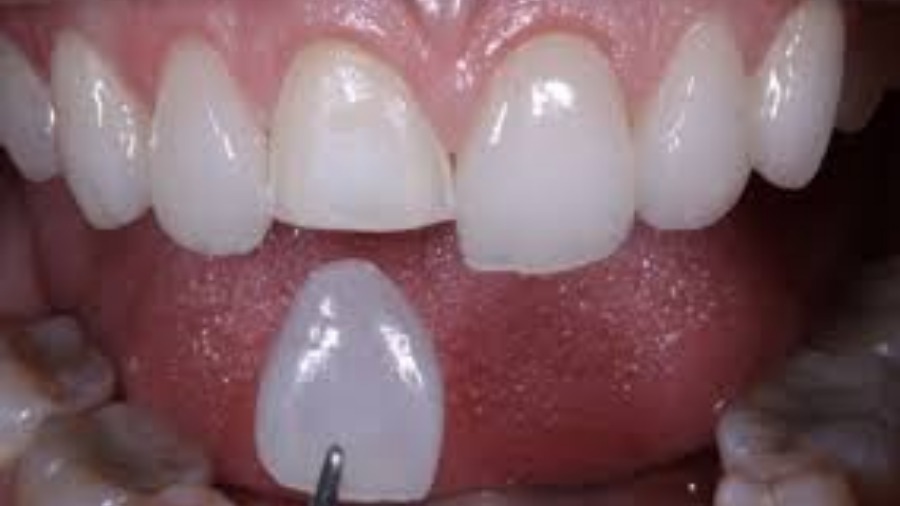 Lentes de Contato e Facetas Dentais